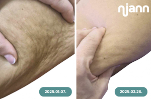 niann narancsbőr ellen